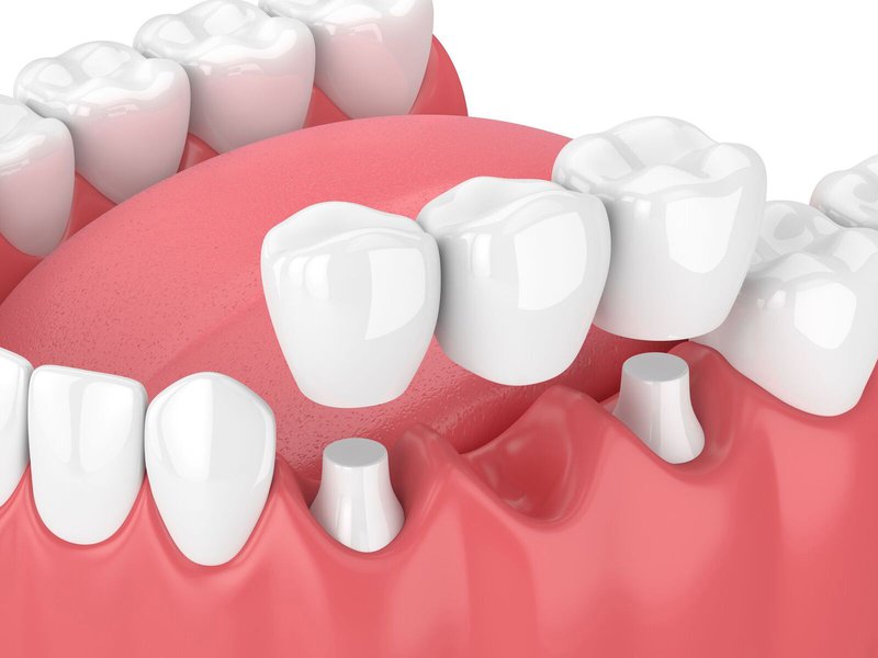 https://mydowntowndental.ca/bridges/