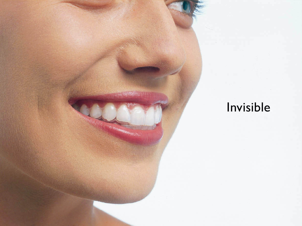 Invisible Braces - Downtown Dental